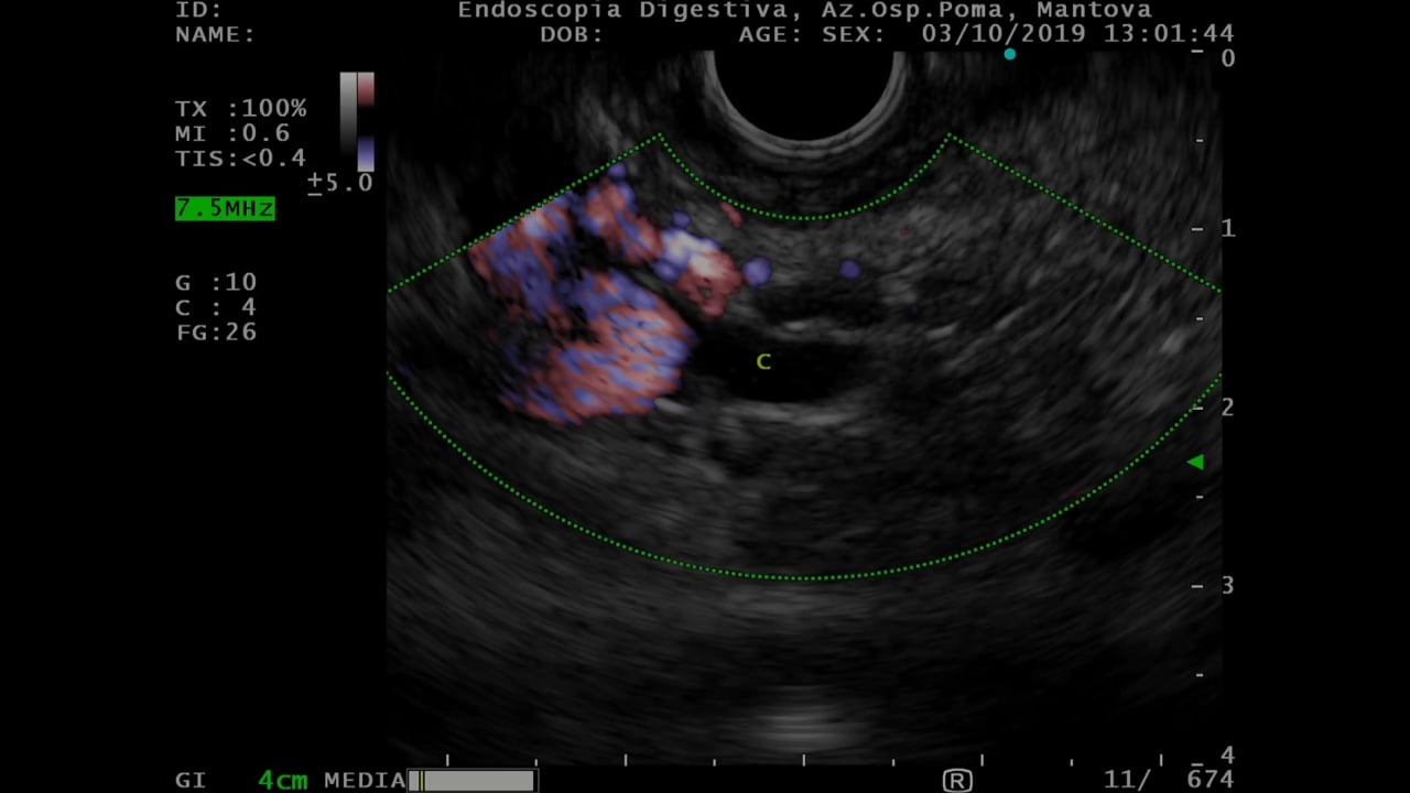 Periduodenal collateral veins in portal hypertension.mp4