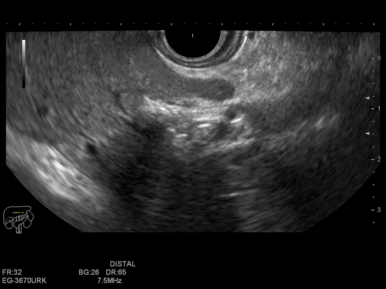 Intrahepatic stones