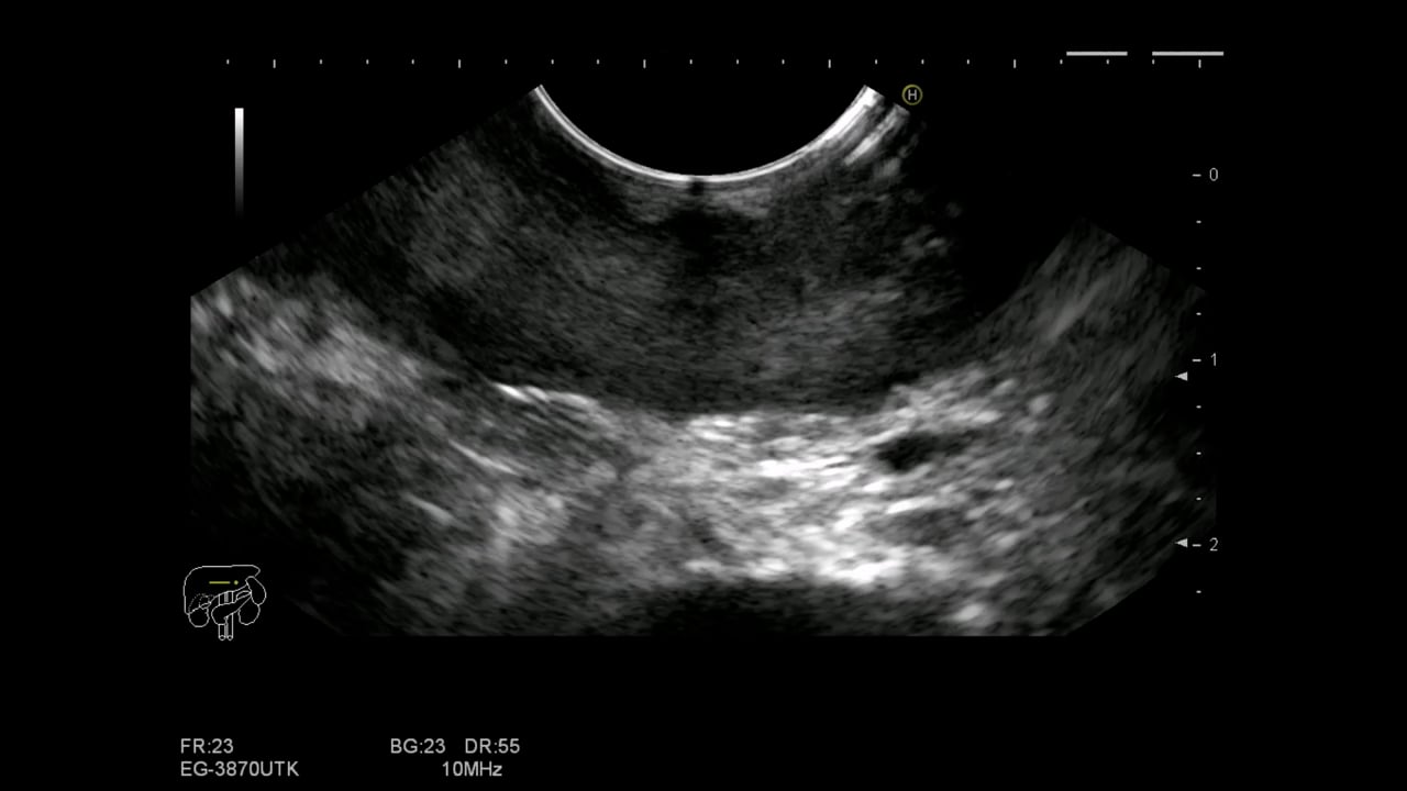 Gastric obstruction due to antral metastatic  infiltration from breast carcinoma