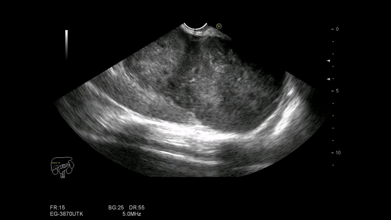 Gastric GIST 1