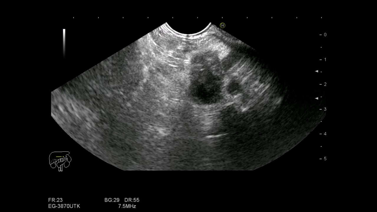FNB of a small  ductal adenocarcinoma of the pancreatic tail