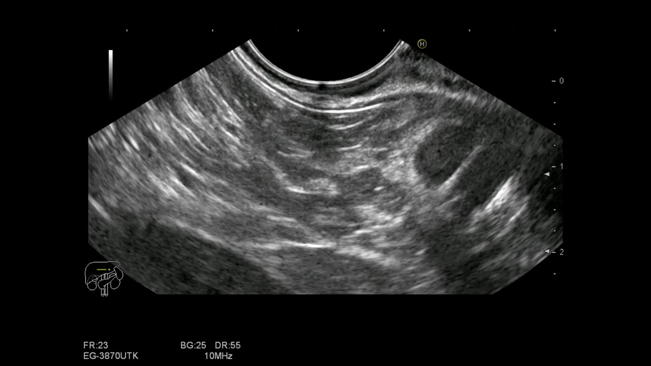 Chronic pancreatitis with several ductal stones